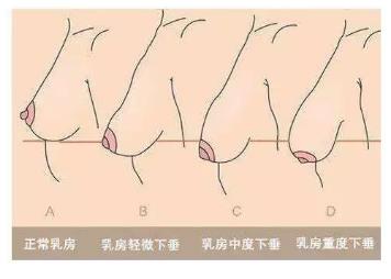 产后乳房对比