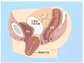 盆底肌修复