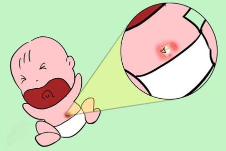 肚脐护理
